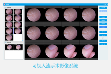 广州慧视科技有限公司-内窥镜影像工作站软件外包定制开发-可视人流手术影像系统
