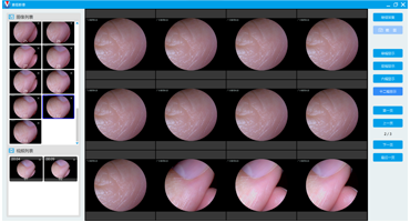 广州慧视科技有限公司-内窥镜影像工作站软件外包定制开发-可视人流手术影像系统